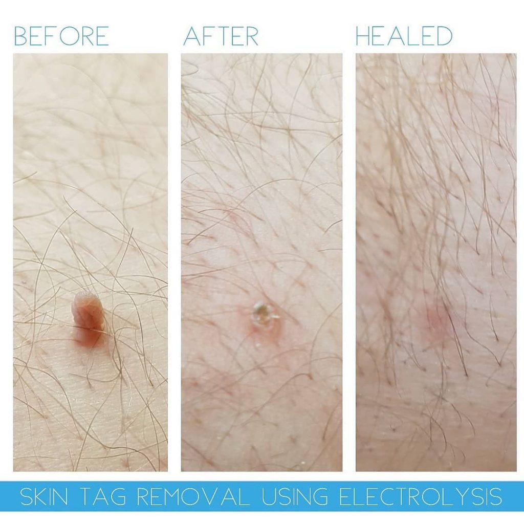 Helena Fryer Skin tag removal