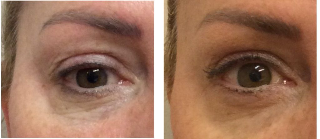 ultraformer mf2 eye treatment