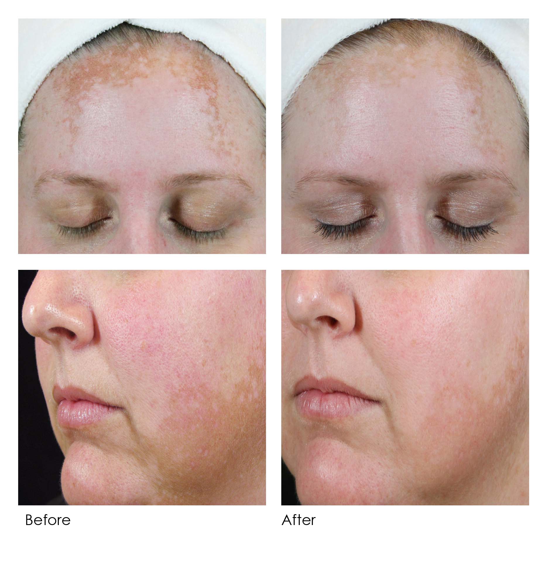 DermaQuest's Skin Brite Peel at Cheshire Lasers, Middlewich.