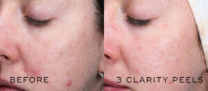 Before and after 3 Medik8 Clarity Peels 