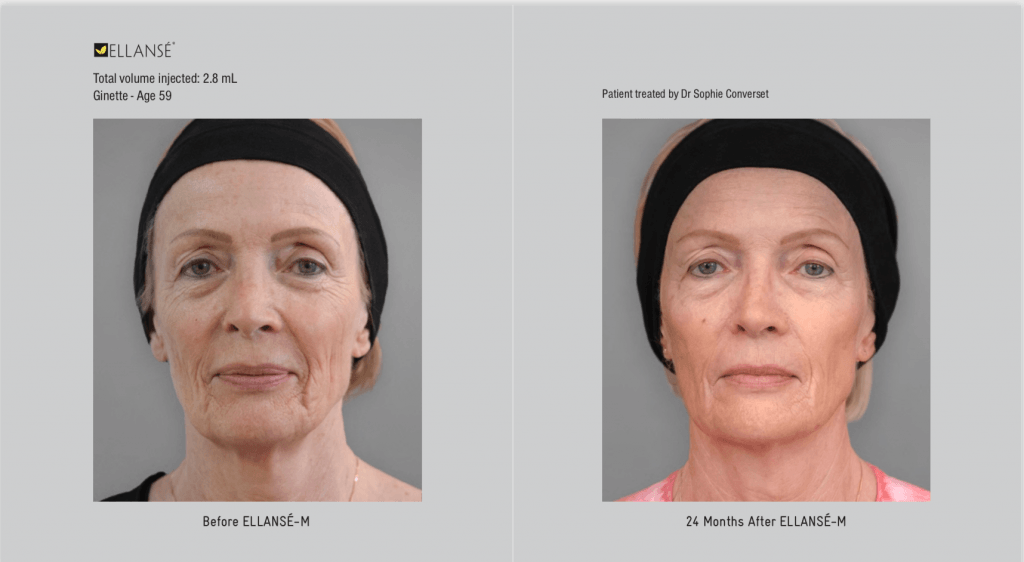 Before and after Ellanse treatment