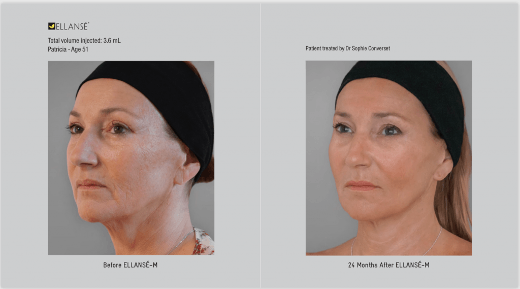 Before and after Ellanse treatment