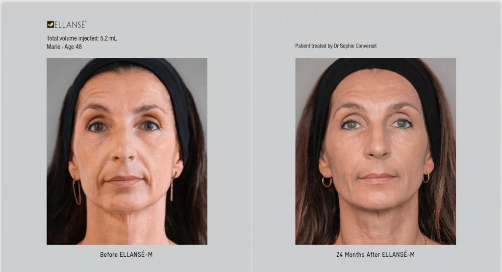 Before and after Ellanse treatment