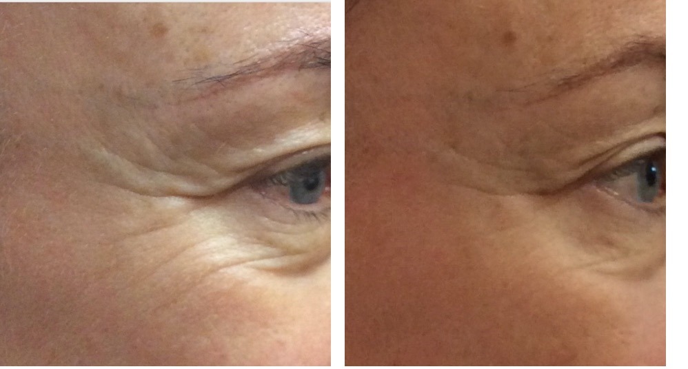 before and after Ultraformer eye treatment