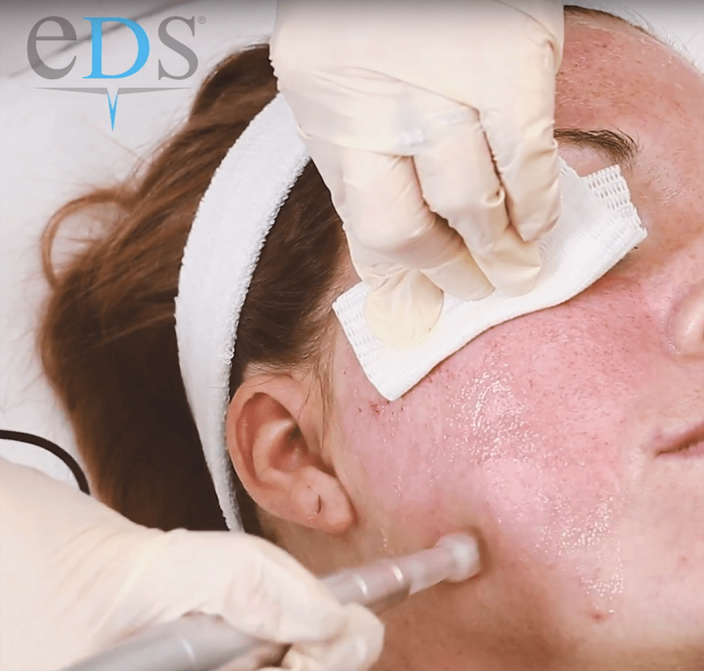 Electronic dermastamp Eds microneedling