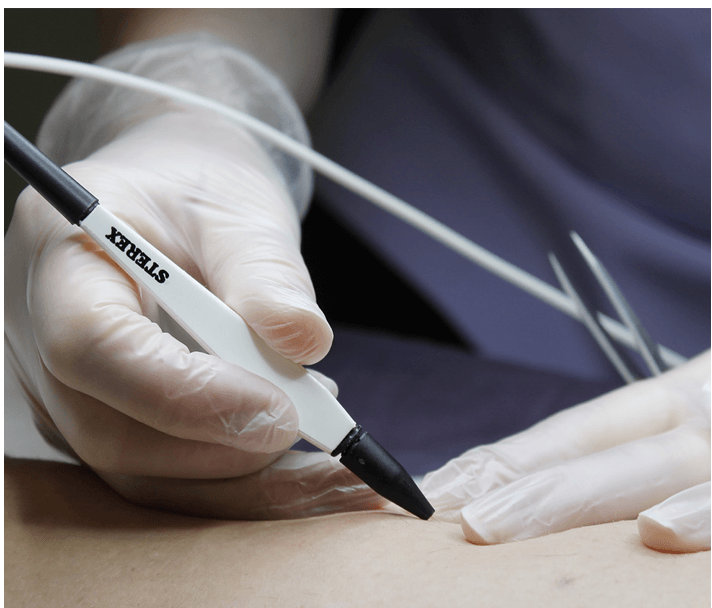 advance electrolysis electrocautery cheshire