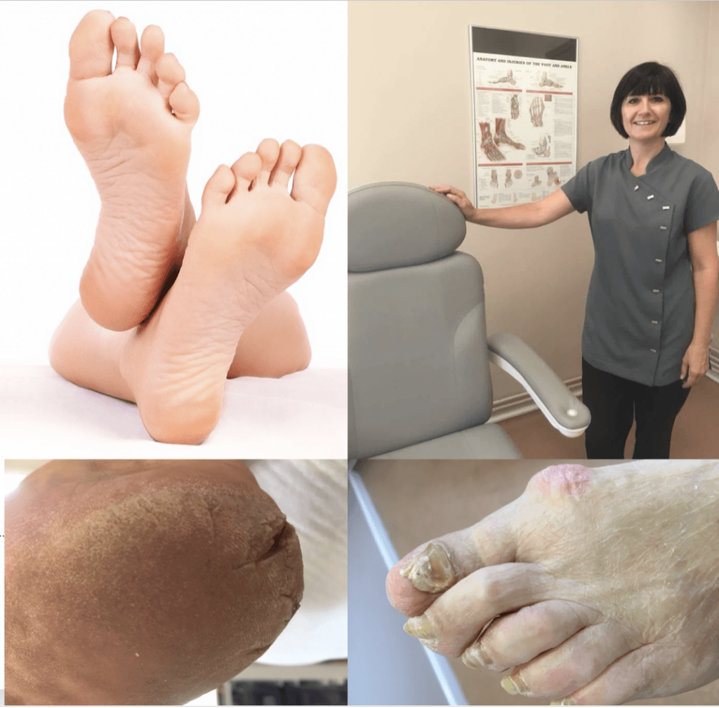 Samantha Hatton podiatry Middlewich Cheshire chiropody