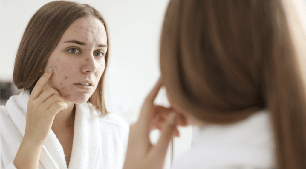 severe acne treatments Cheshire