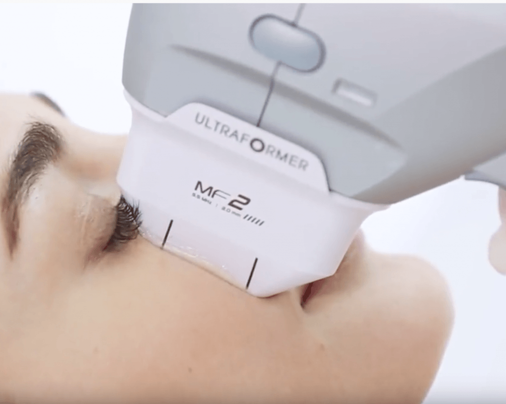 treatment for lines on the cheeks