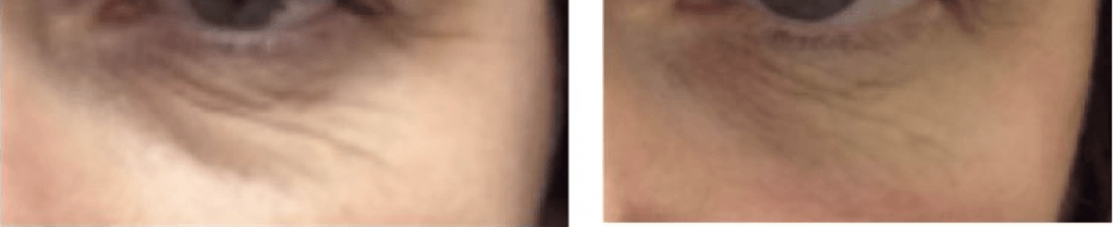 under eye wrinkle treatment radiofrequency