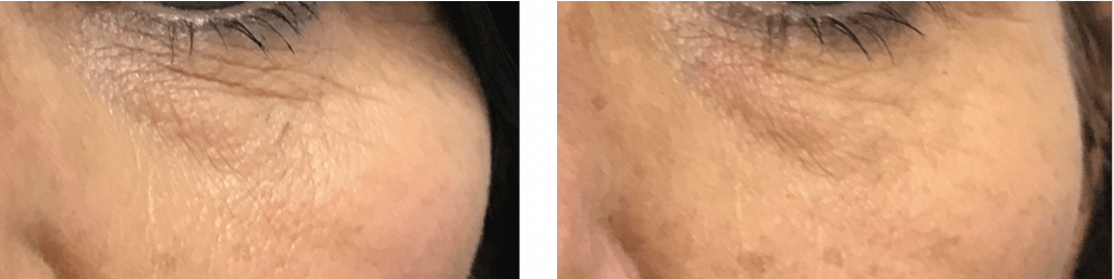 ultraformer mf2 under eye treatment