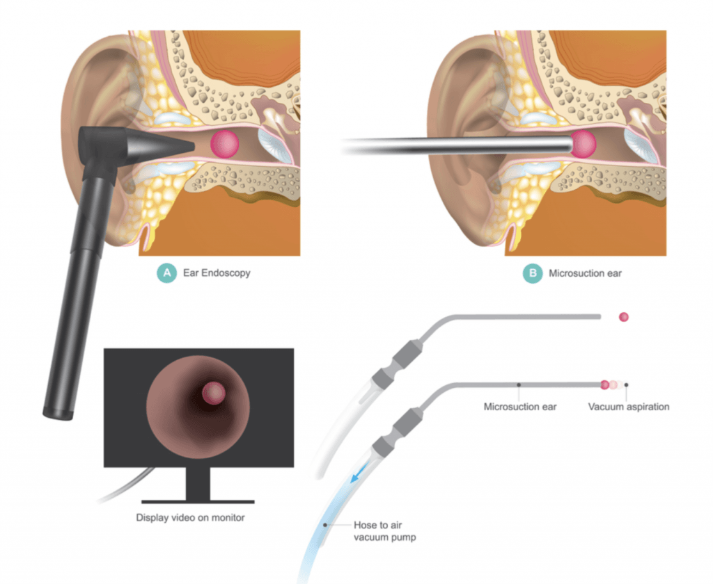 earwax removal Derby