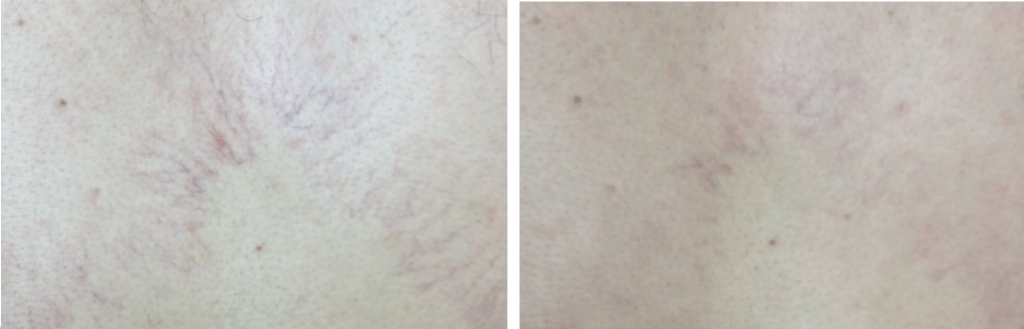 thread vein removal Cheshire