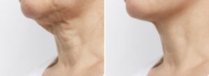 Neck Rejuvenation and Turkey Neck Treatments