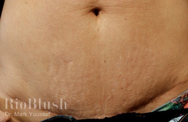 carboxytherapy before