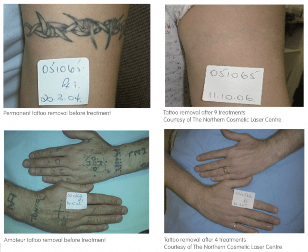 Laser Tattoo Removal Virginia Beach | David H. McDaniel, MD Laser Center  and Medical Spa