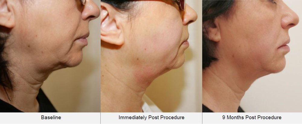 Treatment for Sagging Jowls | Get Rid of Jowls Without Surgery