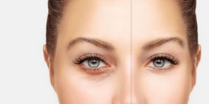 dark circles treatment Cheshire