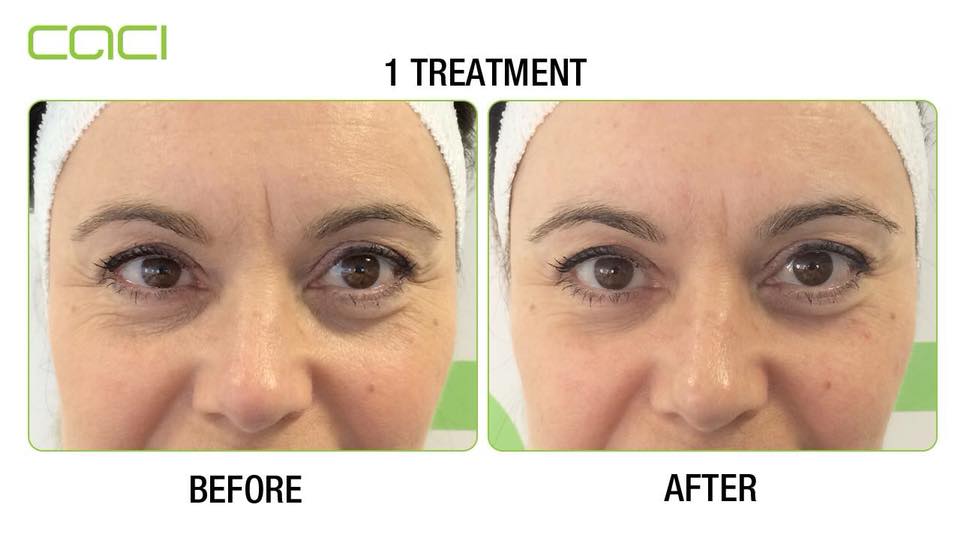 Before and after Caci Eye Revive