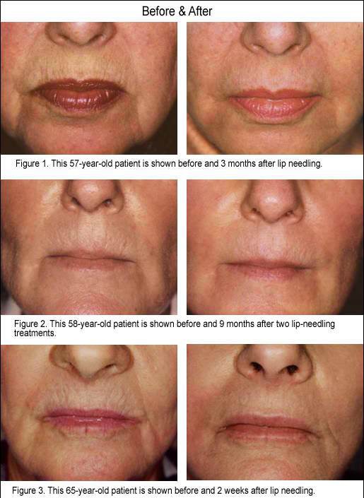 before and after Dermapen Cheshire