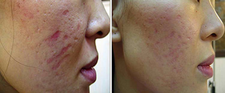 Dermapen before and after Cheshire