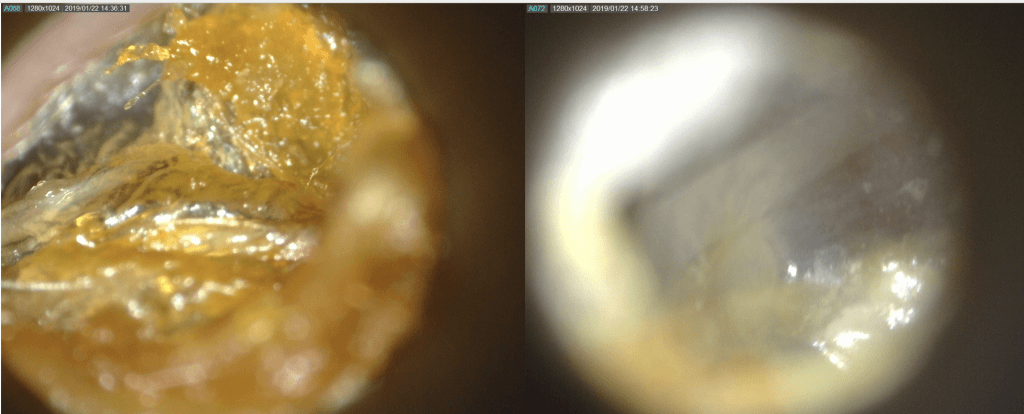 earwax removal Cheshire