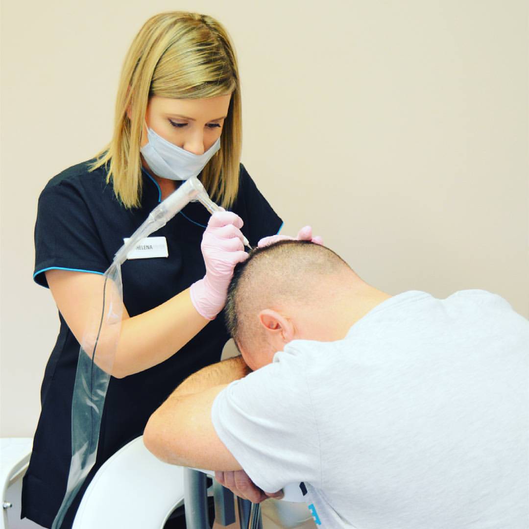 Helena Fryer performing Scalp Micropigmentation / medical scalp tattoo treatment in Middlewich Cheshire