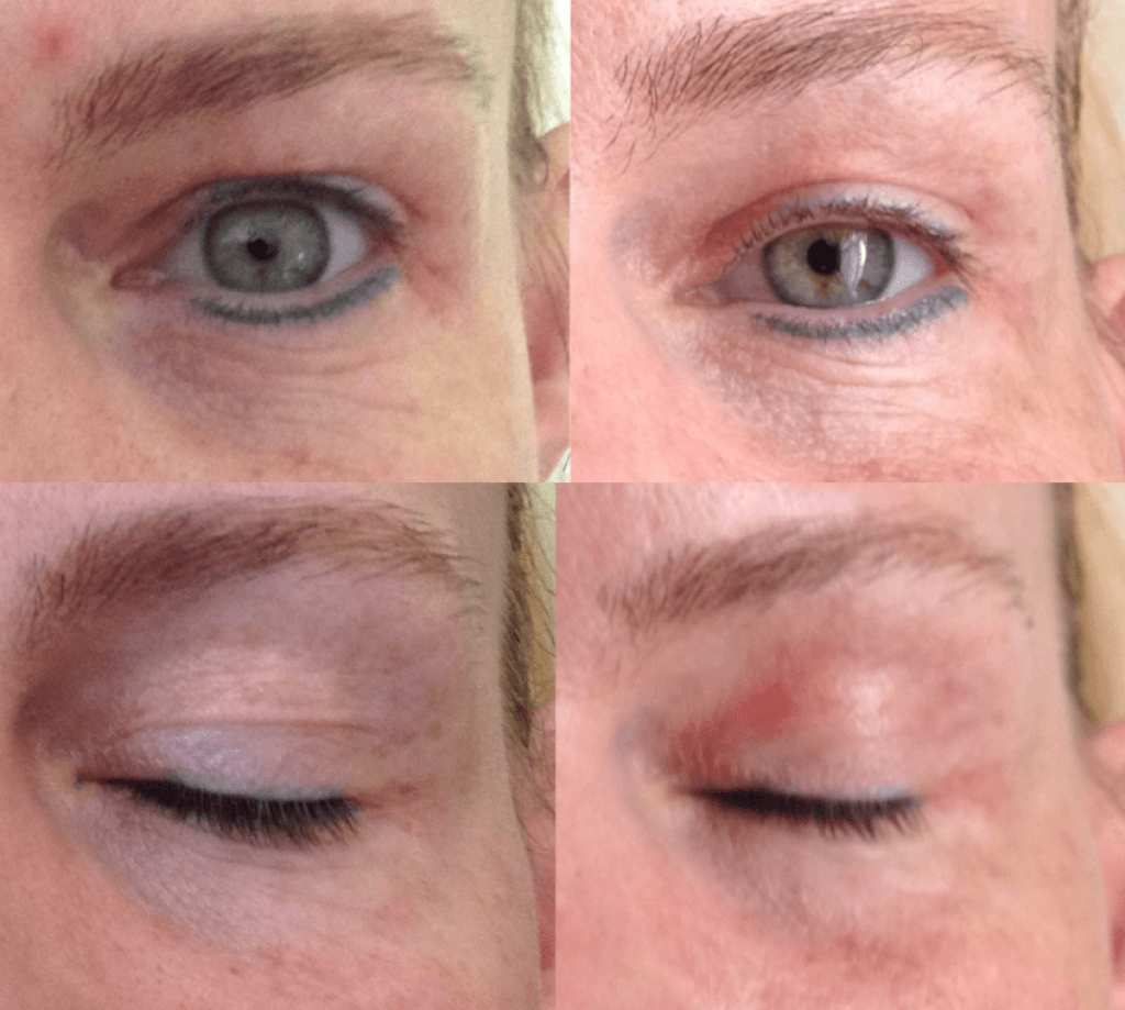 Jett Plasma Skin Treatments At Cheshire Lasers Middlewich jett-plasma-skin-treatments-at-cheshire-lasers-middlewich