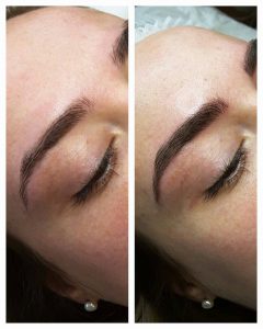 microblading lasers cheshirelasers