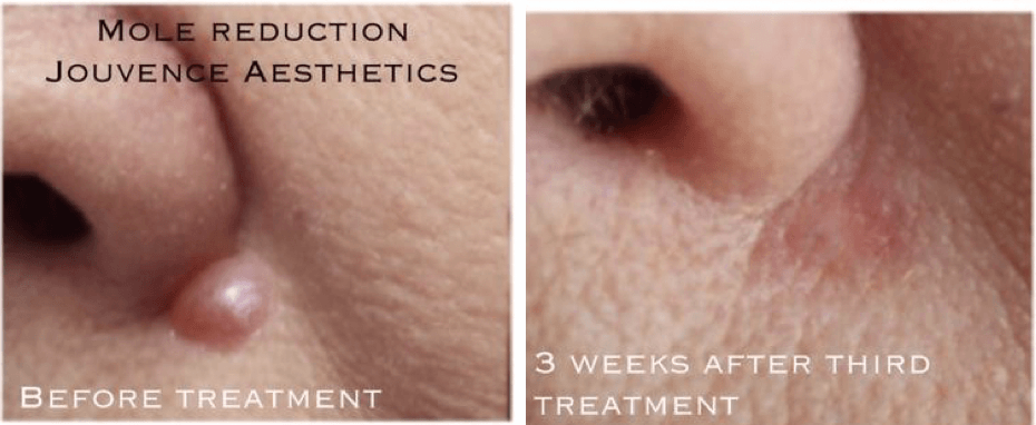 mole removal reduction cheshire