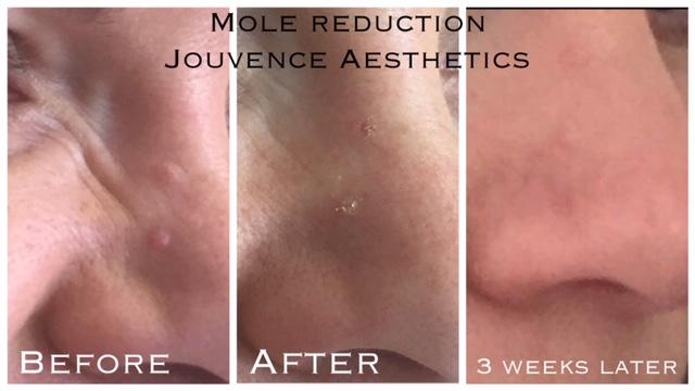 mole removal cheshire