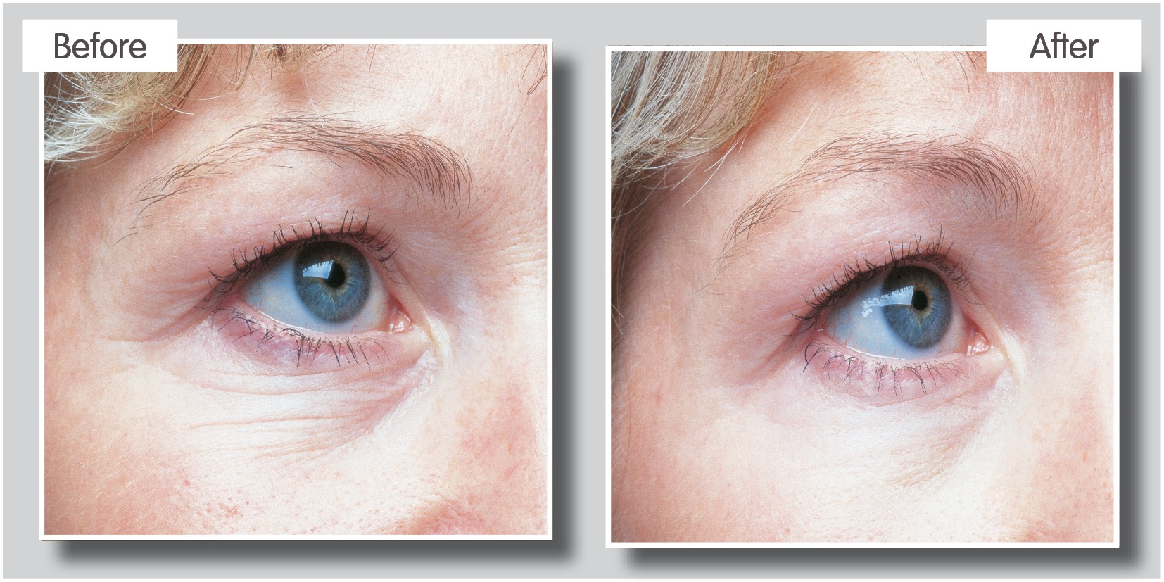 Cheshire Lasers - Omnilux LED Light Therapy in Middlewich.