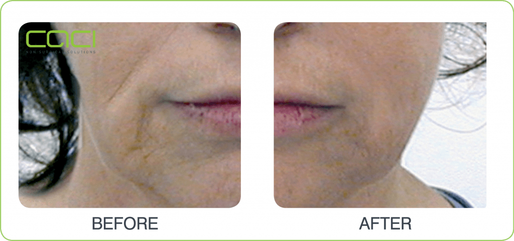 before and after CACI Non Surgical Facelift Jowl Lift Middlewich Cheshire