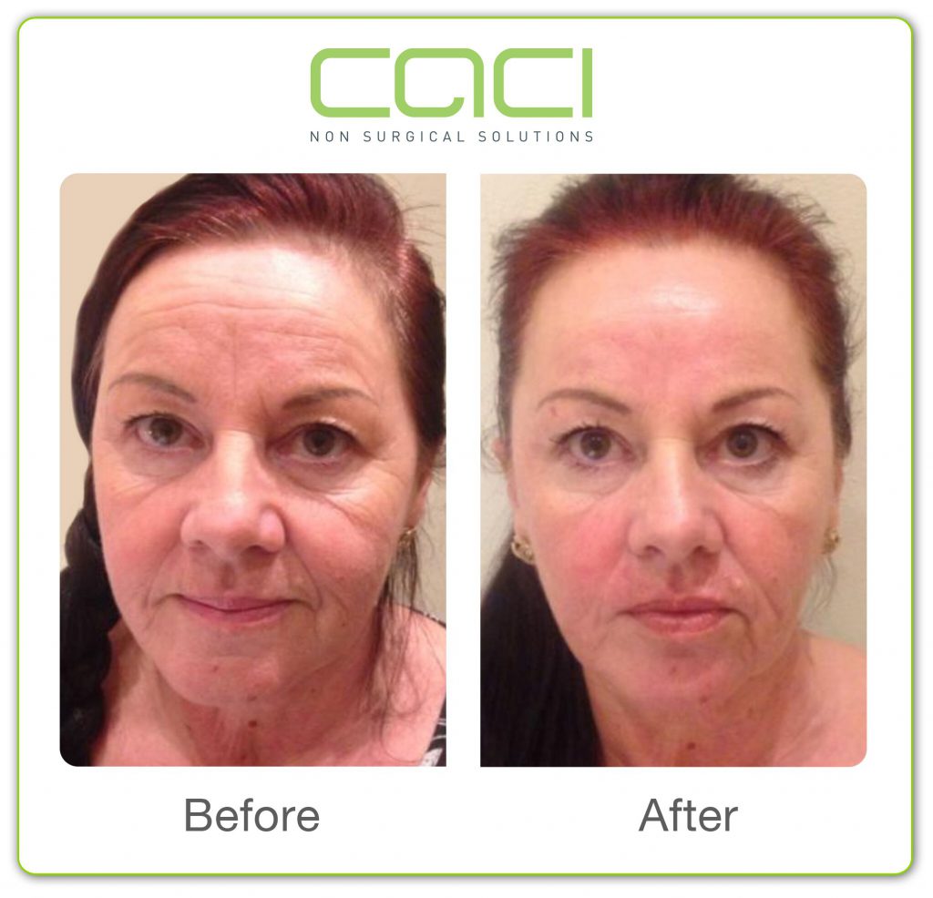 before and after CACI Non Surgical Facelift