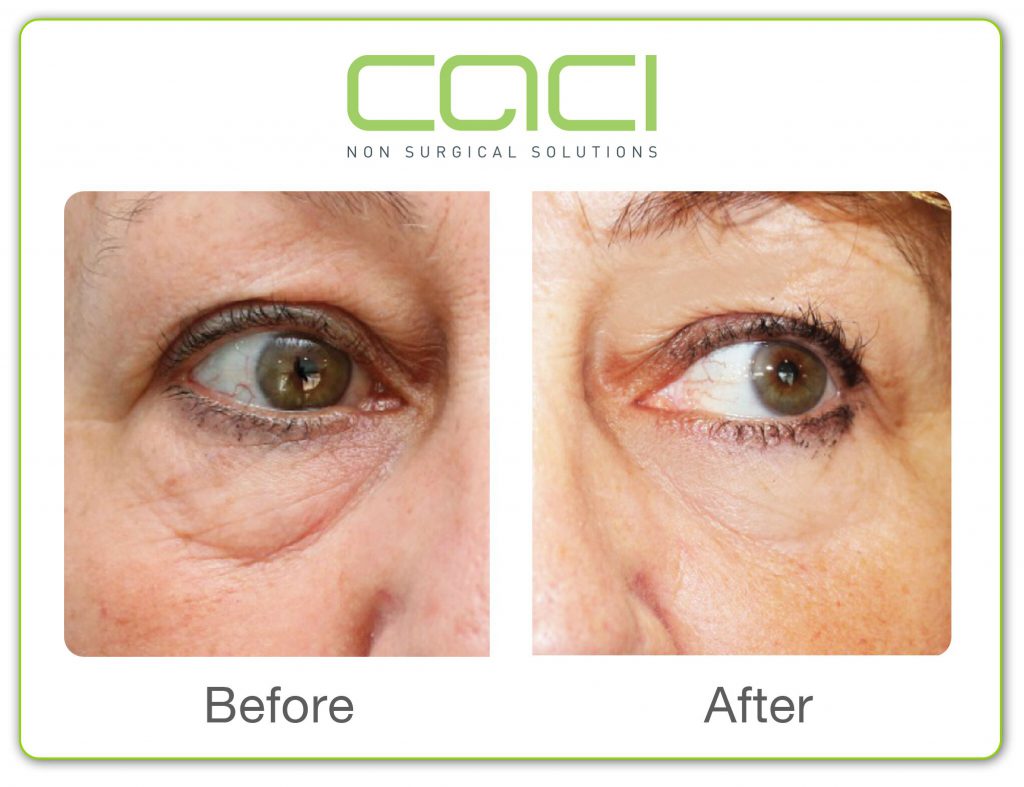 Before and after CACI Eye treatment