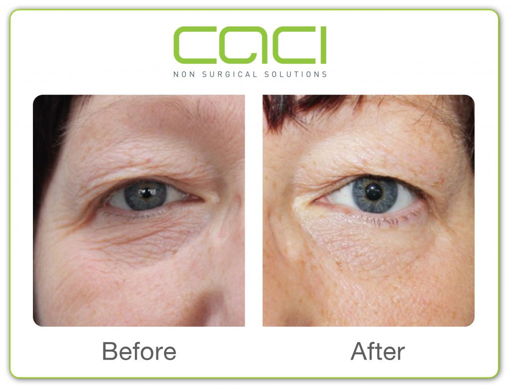 Before and after CACI Eye treatment middlewich Cheshire