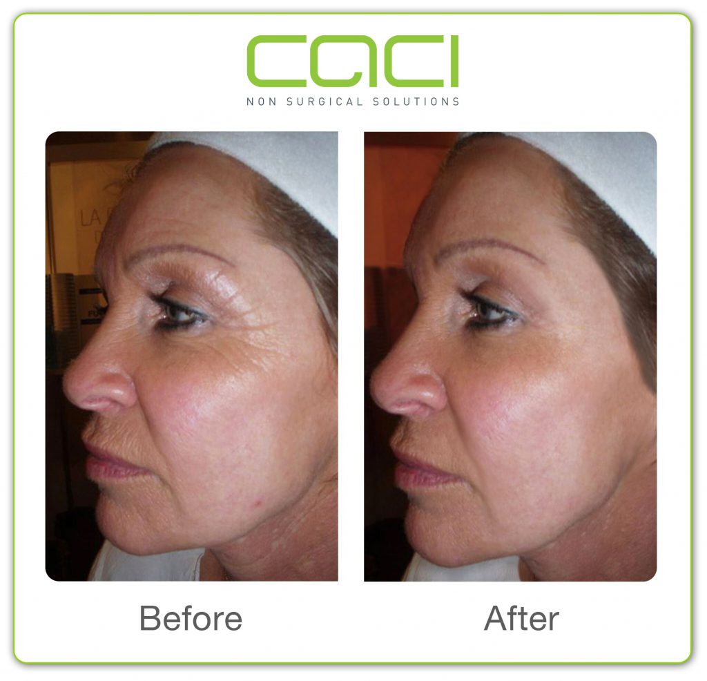 before and after CACI Non Surgical Facelift in Middlewich Cheshire