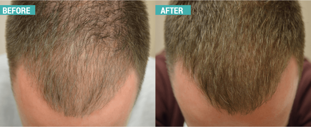 scalp tattoo treatment cheshire