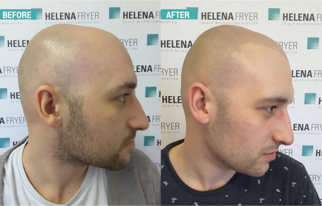 scalp micropigmentation cheshire