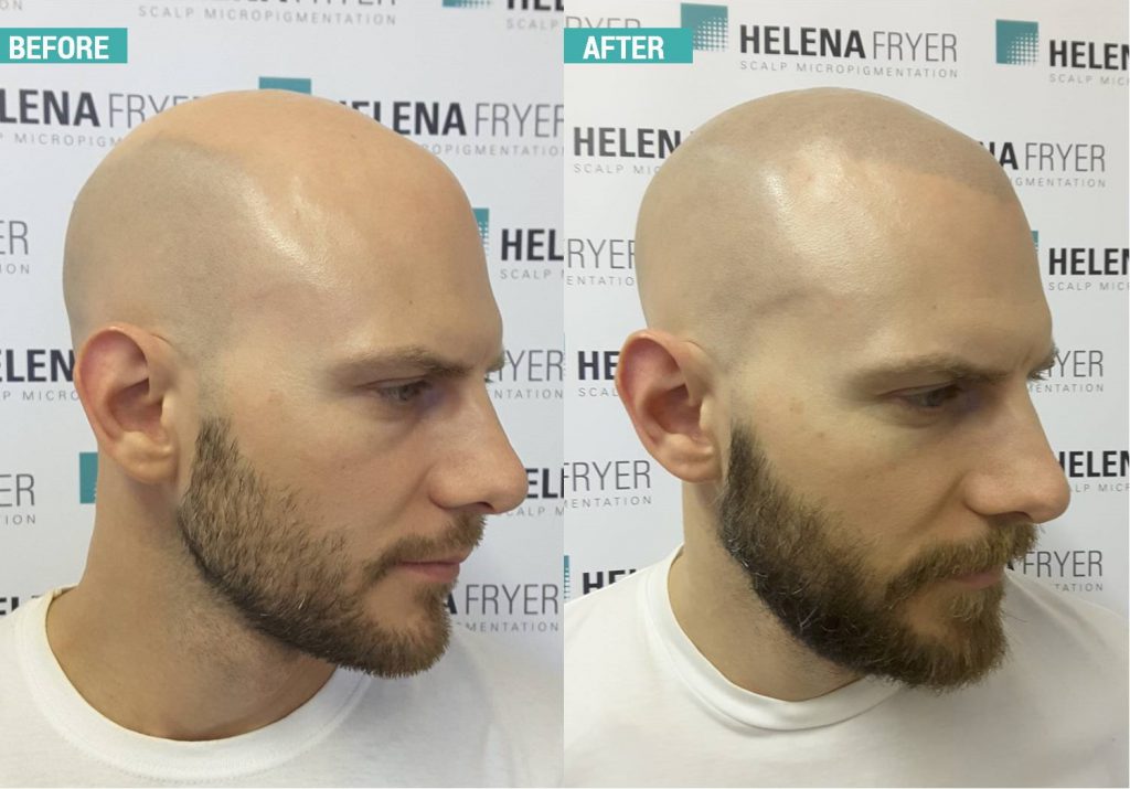 Visum hvad som helst Cyclops Scalp Micropigmentation at Cheshire Lasers, Middlewich.