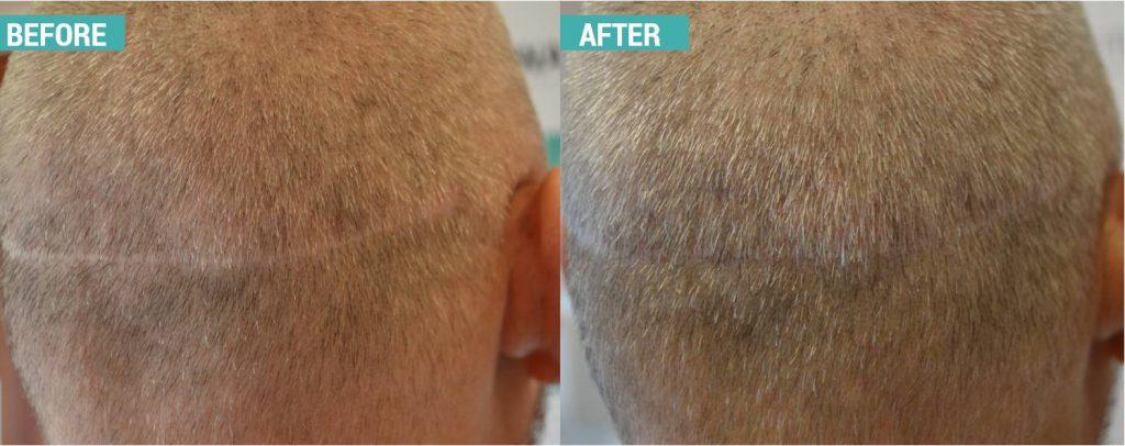 scalp micropigmentation cheshire post hair transplant