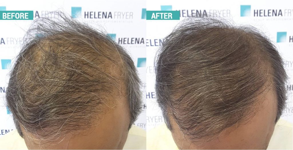 scalp micropigmentation cheshire