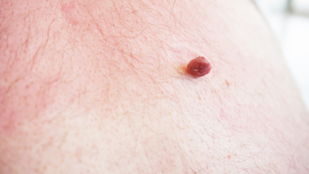 skin tag removal Cheshire