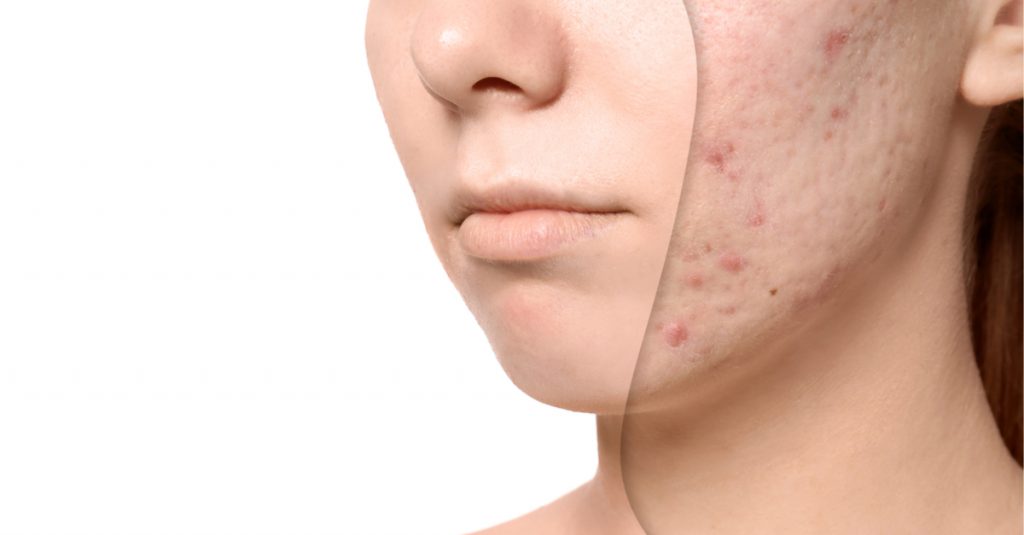 Acne treatments Cheshire