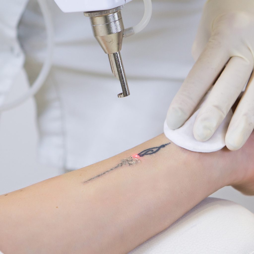 Tattoo removal Cheshire