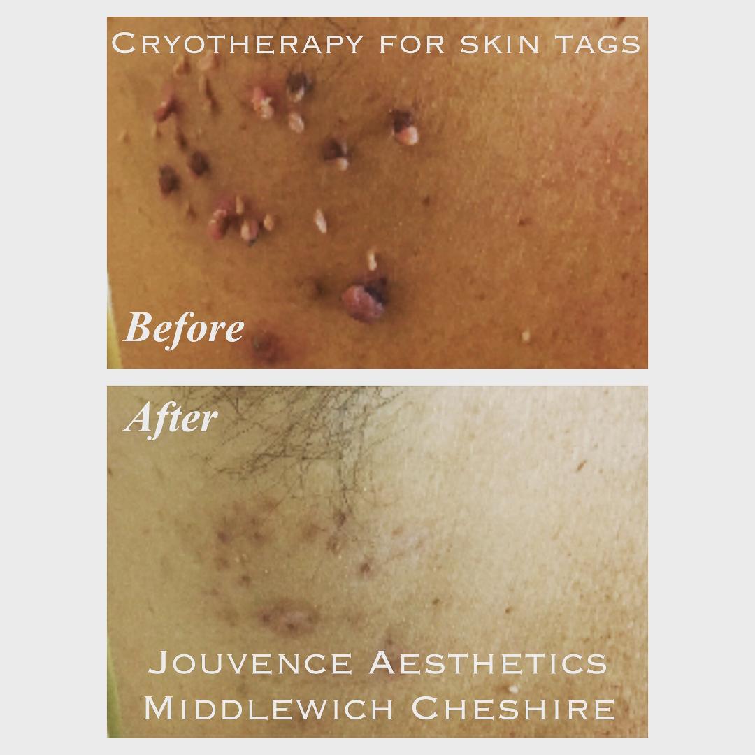 skin tag removal Cheshire