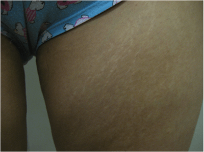 stretch marks treatments Cheshire
