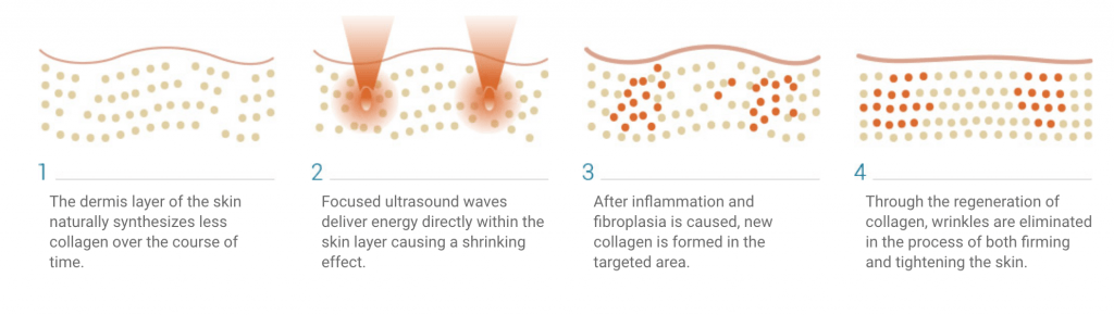 How ultraformer works