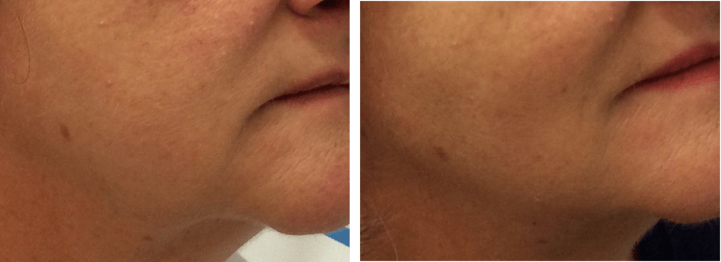 before and after ultraformer jowl treatment