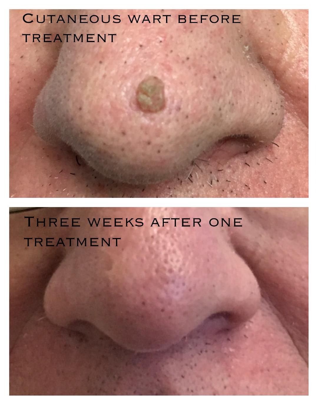 warts treatment uk)